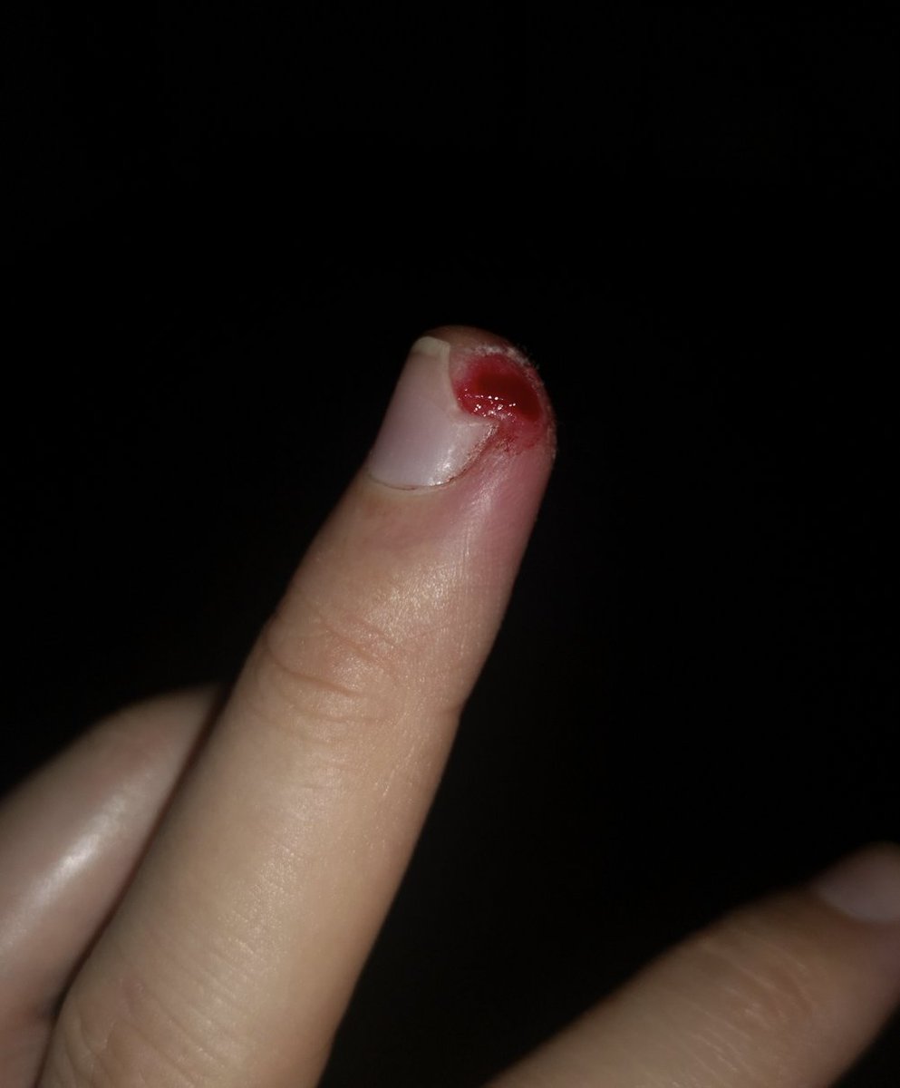 jackwattsmusic's tweet photo. So there was gonna be an acoustic version, but unfortunately it's going to have to wait till this heals! Sorry to the squeamish! Happy Friday ❤️ https://t.co/ox49O8aIzT