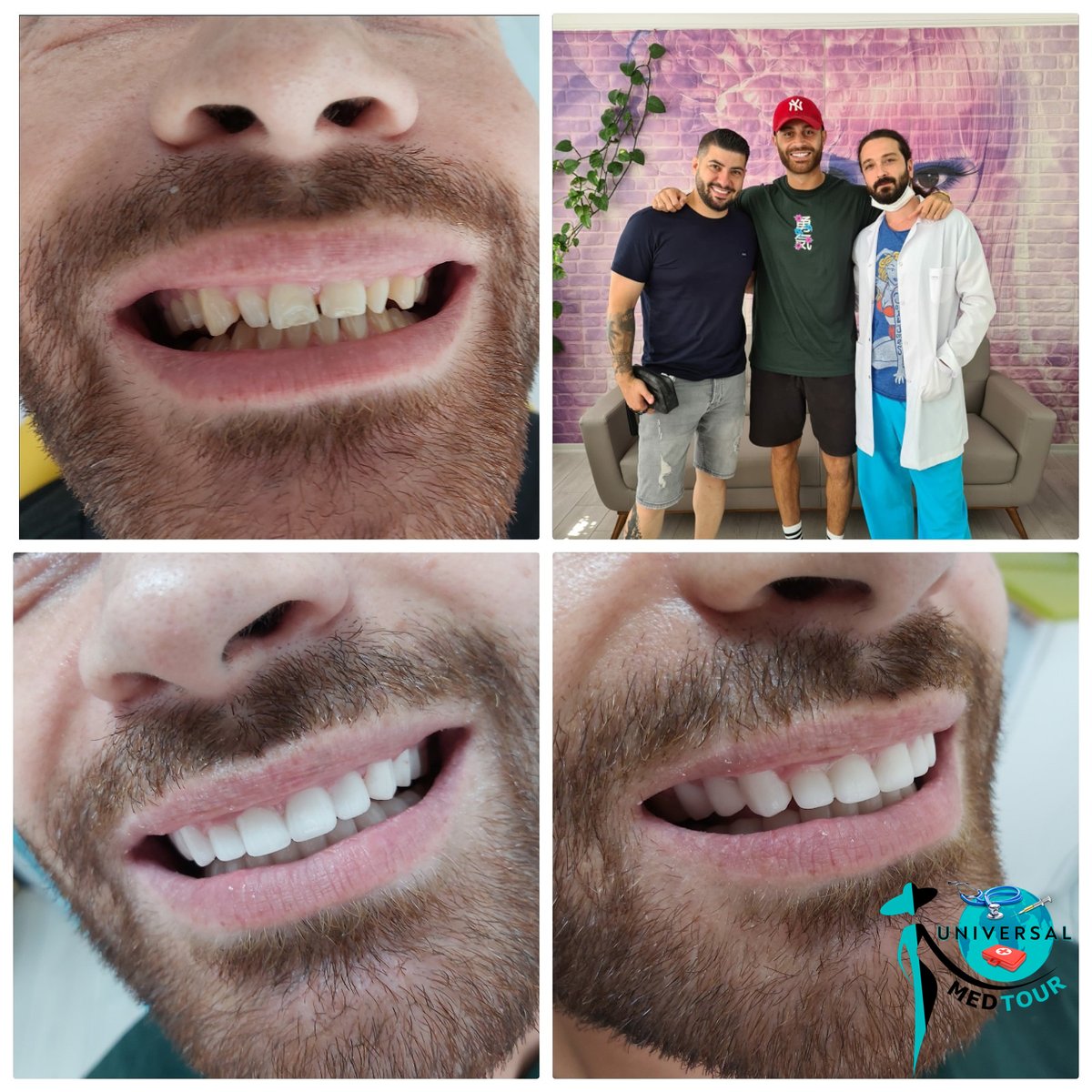 MedUniversal's tweet photo. Happy Client with an amazing smile! 😊
DM us now to get a quote today.
#plasticsurgery #estetik #aestheticsurgeryistanbul #viptransfer #bookusnow #newface #newbody #newappearance #appointments #easy #healthyteeth #oralhealth #universalmedtour #teethhealth #dentist #dentalcare https://t.co/0X11GafUA8