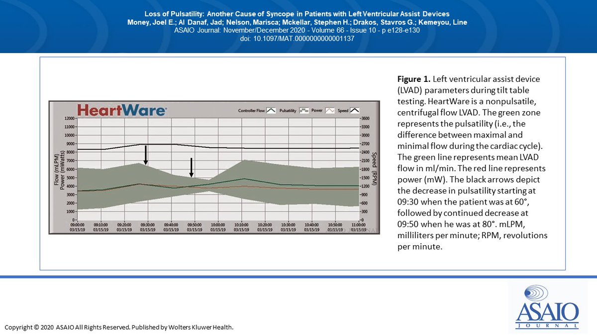 asaiojournal's tweet image. #FREE Loss of Pulsatility: Another Cause of Syncope in Patients with Left Ventricular Assist Devices
ow.ly/Wayo50CD4Ni
@JoelMoneyMD  @jadzdanaf @StavrosDrakos @SHMcKellarMD @LKemeyou @mariscanelson

#Syncope #pulsatility #LVAD #HeartFailure