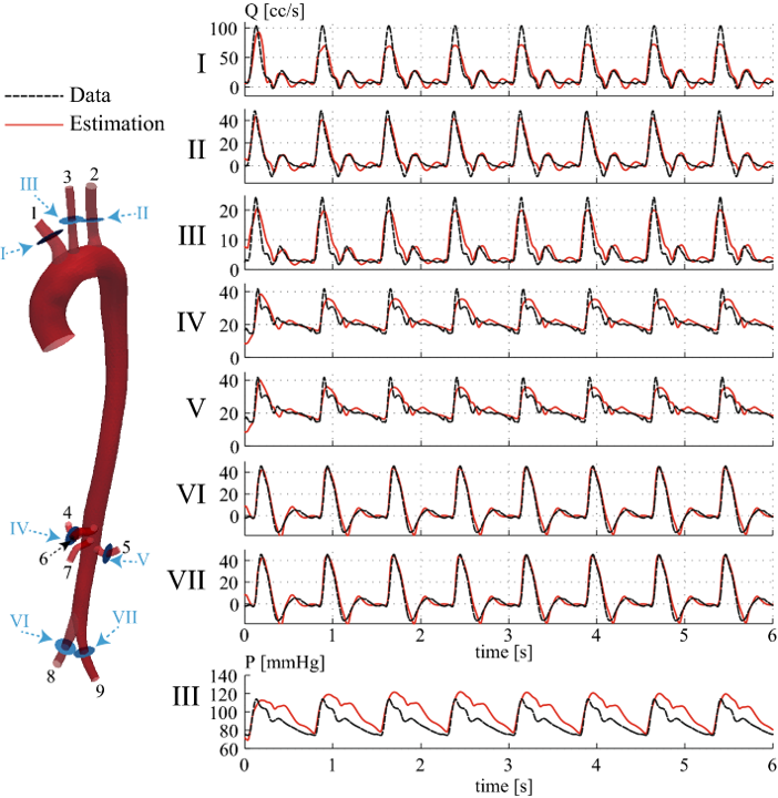 C. Alberto Figueroa (@bloodflowsim) on Twitter photo Our paper on CV data assimilation (stiffness, outflow BCs) is out. Thank you to <a href="/carthu15p/">Christopher J Arthurs</a> , Dr. Nan Xiao, <a href="/PhilippeMoireau/">Philippe Moireau</a>, and Professor. Schaeffter!
Methods implemented in <a href="/CRIMSONsoftware/">CRIMSONsoftware</a>
amses-journal.springeropen.com/articles/10.11…
<a href="/UM_MICDE/">MICDE</a> <a href="/UMBME/">U-M BME</a> <a href="/umichCVC/">U-M Health Frankel CVC</a> <a href="/UoMVascSurgery/">UoM Vascular Surgery</a>
#openaccess Our paper on CV data assimilation (stiffness, outflow BCs) is out. Thank you to <a href="/carthu15p/">Christopher J Arthurs</a> , Dr. Nan Xiao, <a href="/PhilippeMoireau/">Philippe Moireau</a>, and Professor. Schaeffter!
Methods implemented in <a href="/CRIMSONsoftware/">CRIMSONsoftware</a>
amses-journal.springeropen.com/articles/10.11…
<a href="/UM_MICDE/">MICDE</a> <a href="/UMBME/">U-M BME</a> <a href="/umichCVC/">U-M Health Frankel CVC</a> <a href="/UoMVascSurgery/">UoM Vascular Surgery</a>
#openaccess