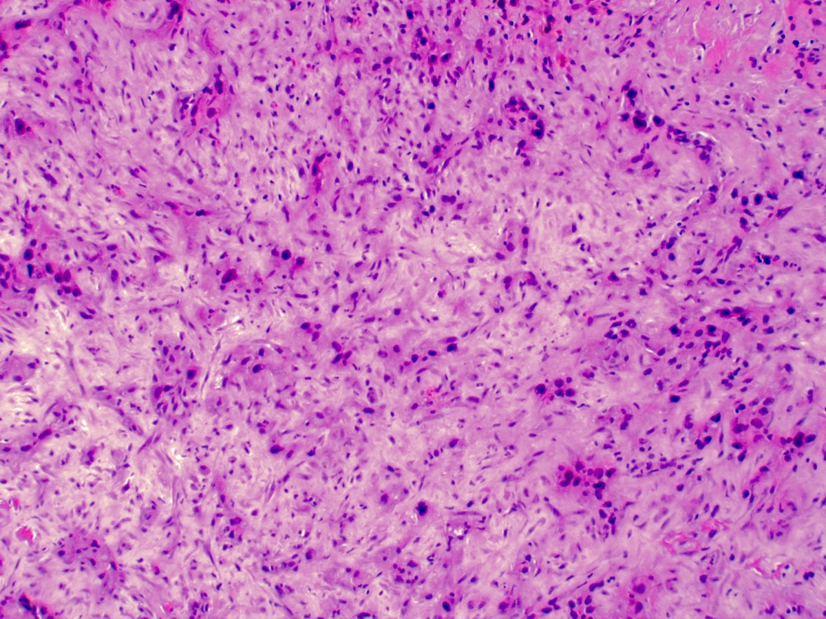 5. Finally, we have a peripheral lung lesion in a 54-year-old female with a history of breast cancer.