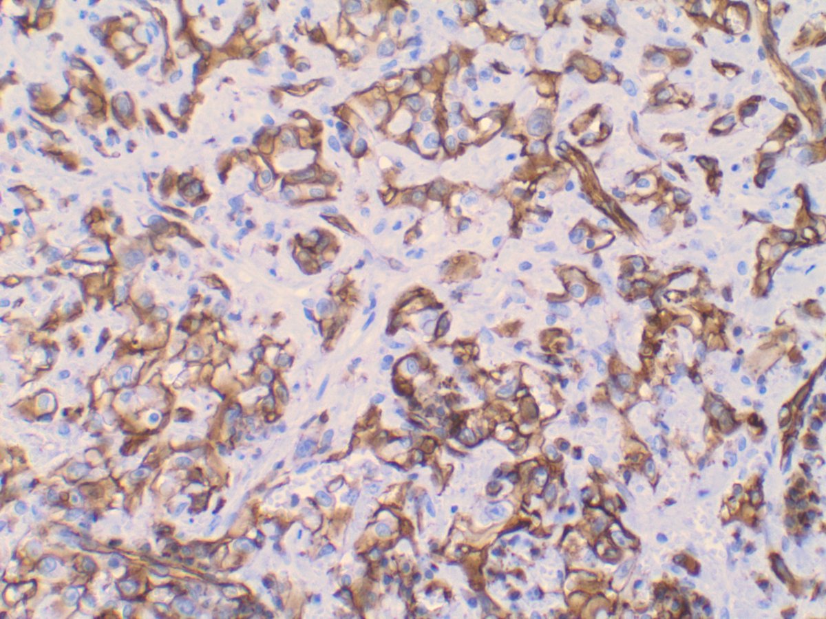 Not exactly classic, but for the sake of argument, hemorrhage and hemosiderin were abundant in other sections. CD31 highlights the vascular etiology of this lesion.