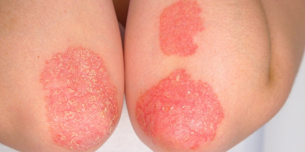 MDedgeDerm's tweet photo. Study links PCOS to a higher risk of psoriasis. https://t.co/XjT6teq6AU #GRAPPA2020 #skinchat https://t.co/unNhaK8ual