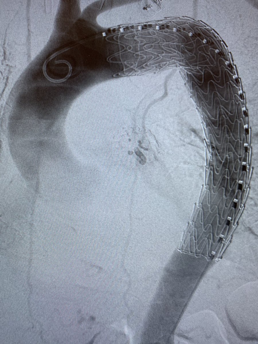 DanielMilesMD (@danielmilesmd) on Twitter photo Sliding into the (call) weekend with a nice Zone II TEVAR for symptomatic PAU/IMH - staged following L CCA - L SCA bypass, of course! <a href="/VascSurgLA/">Vascular Surgery Associates</a> <a href="/AortophilicMD/">Cassra N. Arbabi MD</a> <a href="/DrAliAzizzadeh/">Ali Azizzadeh</a> <a href="/VascularSurgCS/">Cedars-Sinai Division of Vascular Surgery</a> #vasculartwitter #SoMe4Surgery #MedEd Sliding into the (call) weekend with a nice Zone II TEVAR for symptomatic PAU/IMH - staged following L CCA - L SCA bypass, of course! <a href="/VascSurgLA/">Vascular Surgery Associates</a> <a href="/AortophilicMD/">Cassra N. Arbabi MD</a> <a href="/DrAliAzizzadeh/">Ali Azizzadeh</a> <a href="/VascularSurgCS/">Cedars-Sinai Division of Vascular Surgery</a> #vasculartwitter #SoMe4Surgery #MedEd