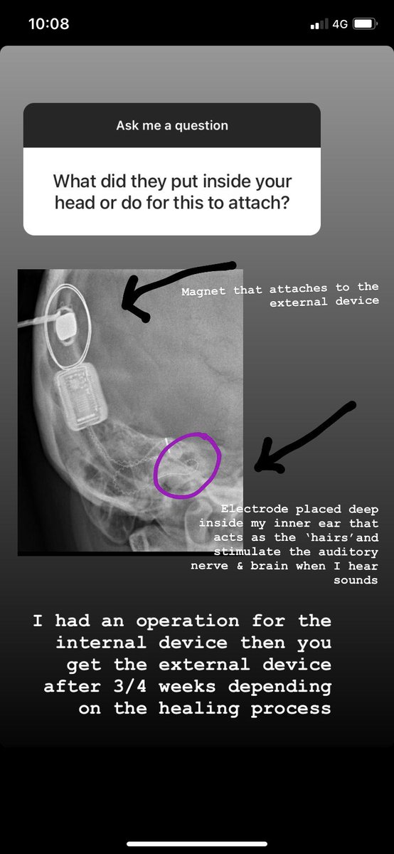 : I had a lot of people messaging about my ‘activation day’. So just gonna pot the questions I answered. *PLEASE REMEMBER, everyone’s activation day is completely different* This is just mine & my perception.
