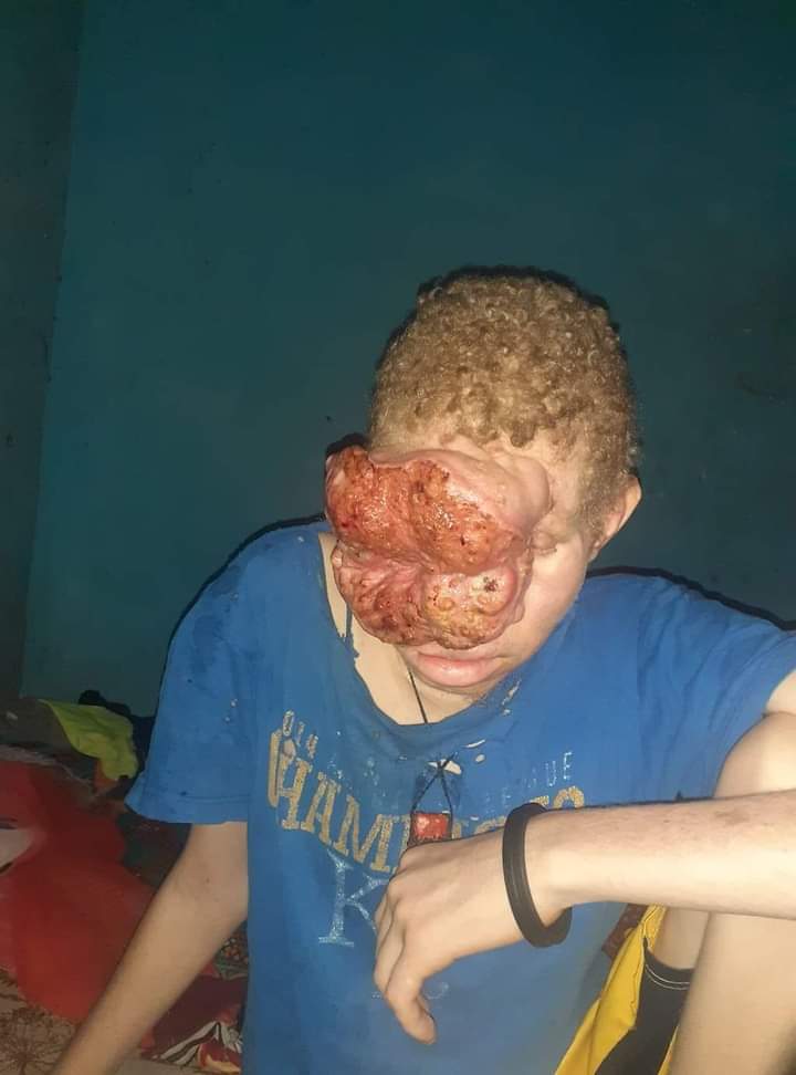 AJLMEOfficiel's tweet photo. ??#Urgent#🚨
Nouhan Condé, orphelin de père et de mère âgé de 14ans et résident de kankan souffre d'une grave tumeur faciale. Nous demandons aux de bonne volonté de venir en aide à ce petit garçon
Pour toute information vous pouvez contacter ce numéro.
+224623958130
Partagez. https://t.co/ODg6zPjWBq