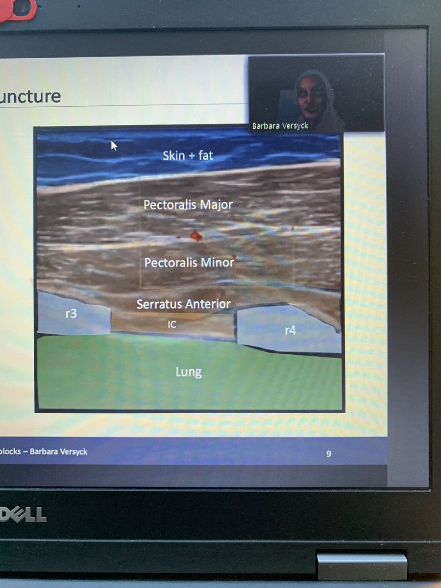 koenvhb's tweet photo. Zeer duidelijke en boeiende presentatie van @BarbaraVersyck over de mogelijkheden van de “Pecs blocks” bij #chronische #pijn . #MedTwitter #NurseTwitter #webinar #PecsBlock #ChronicPain @BPS_IASP https://t.co/N5JUMoNYhY