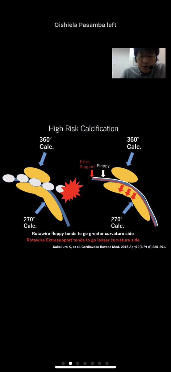 suhninhlaing's tweet image. Awesome Online ROVUS course by A/Prof Kenichi Sakakura !! #rovus @bostonsci #rotablator #rotationalatherectomy