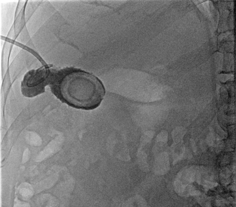 WeillCornell_IR's tweet photo. @WBrowneVIR and IR/DR @waynecolizza helping a non-op patient get rid of a large stone. Stage it with upsize of chole tube 4-6 weeks after infx resolves, scope + lithotripsy in 2-4 weeks, 2 week f/u to check/cap the tube, then remove 2 weeks after! #irad #withoutascalpel @SIR_ECS https://t.co/EwGQroSYVZ