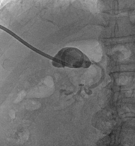 WeillCornell_IR's tweet photo. @WBrowneVIR and IR/DR @waynecolizza helping a non-op patient get rid of a large stone. Stage it with upsize of chole tube 4-6 weeks after infx resolves, scope + lithotripsy in 2-4 weeks, 2 week f/u to check/cap the tube, then remove 2 weeks after! #irad #withoutascalpel @SIR_ECS https://t.co/EwGQroSYVZ