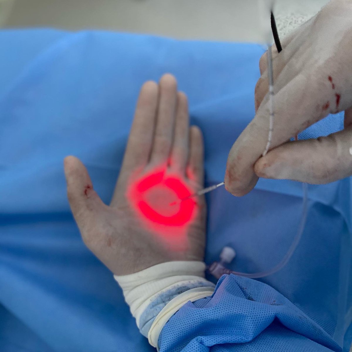 lbncbma's tweet photo. Endolaser Saphenous Vein #endolaser #vascularsurgery #endovascularsurgery https://t.co/nJACtJQK04