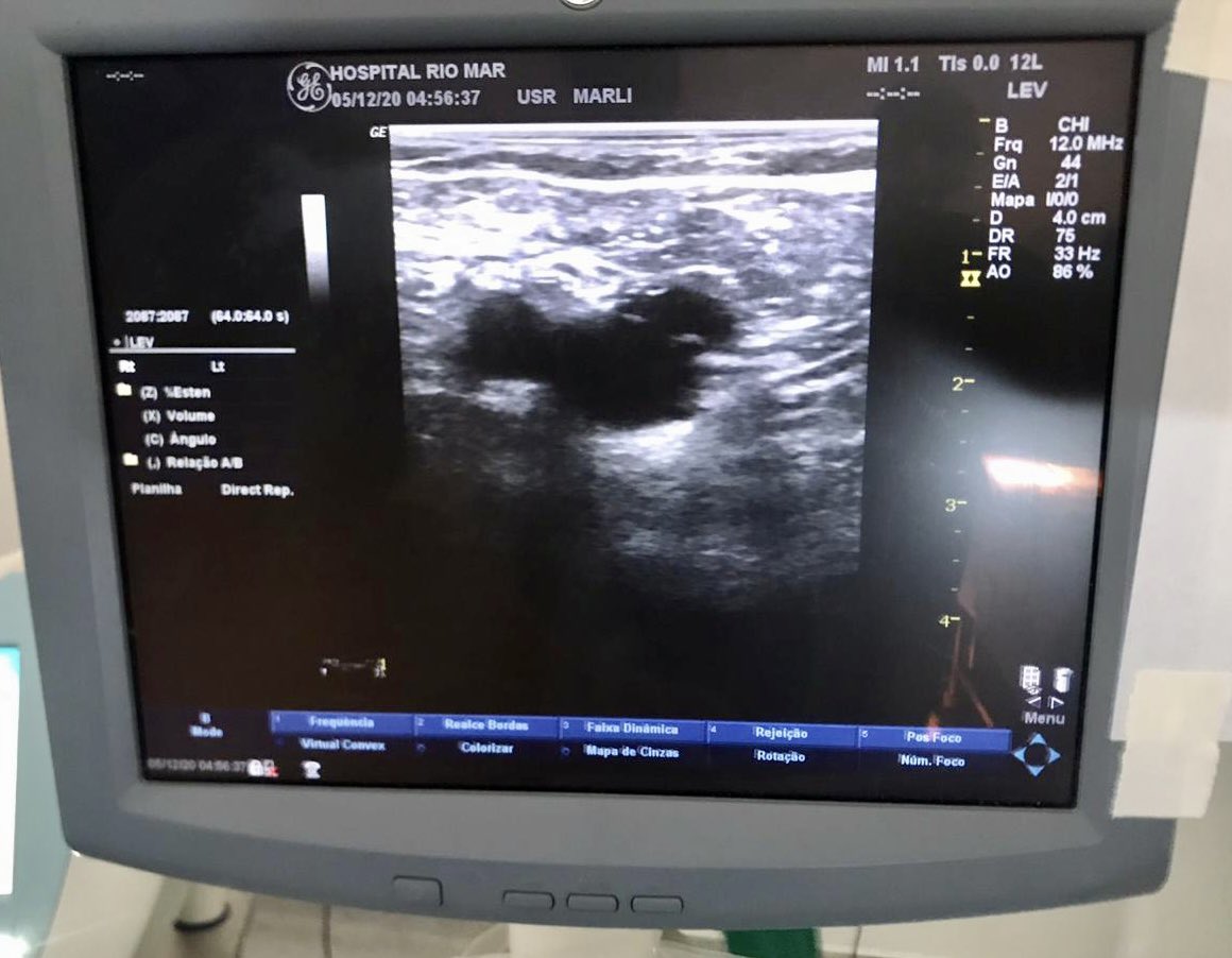 lbncbma's tweet photo. Endolaser Saphenous Vein #endolaser #vascularsurgery #endovascularsurgery https://t.co/nJACtJQK04