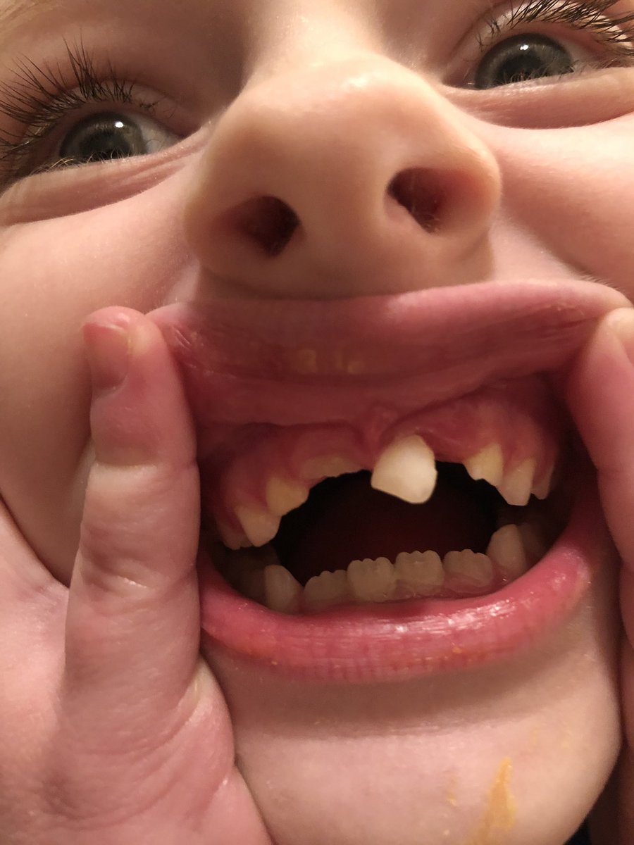 krispekitty's tweet photo. Just lost a tooth in Mississippi!! Will the tooth fairy find us in Tennessee? #toothfairy #dropapin https://t.co/0YIXjq5avw
