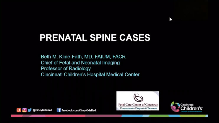 The  #RSNA20 Read Cases with the Experts: Fetal session was one of the highlights of the conference. Dr Beth Kline-Fath set the stage with her discussion of prenatal spine cases https://rsna2020.rsna.org/live-stream/15352103/Read-Cases-with-Experts-Fetal-Cases