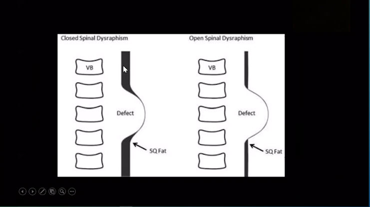 One of our favorite pearls from the  #RSNA20 session has how Dr. Kline-Fath taught us how to differentiate a closed neural tube defect from an open defect. Don't forget to look for the creeping fat