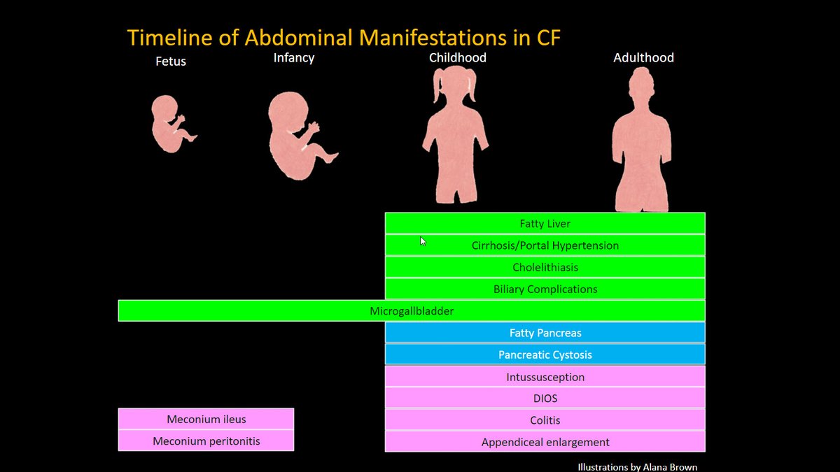 There are so many different abdominal manifestations of  #CysticFibrosis. This  #RSNA20 slide reminds us of many of them and highlights when they can occur