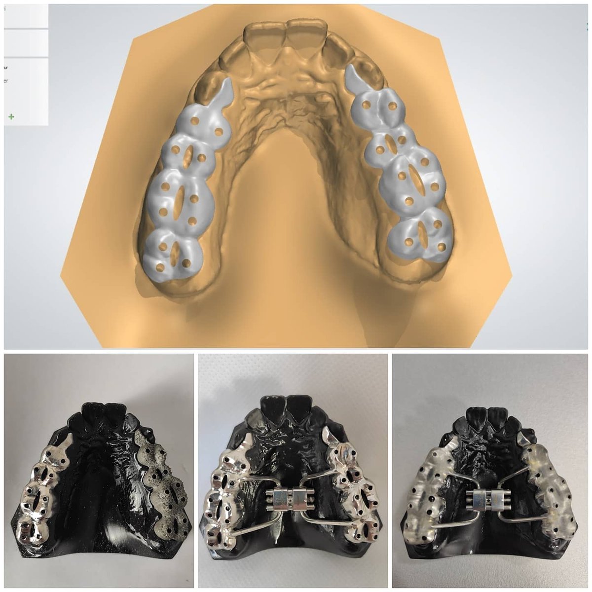 Dijital çalışmalarımıza bazen klasik dokunuşlar yaptığımız oluyor😎 #Ortodontist Veysel Güner bey ile beraber çalıştığımız #DigitalRPE  sonrasında karşı dişlerin temas kısmını akrilik ile finalize ettik 🤓
#hyrax #orthodontics #ortodonti #orthodontist #Digitalorthodontics