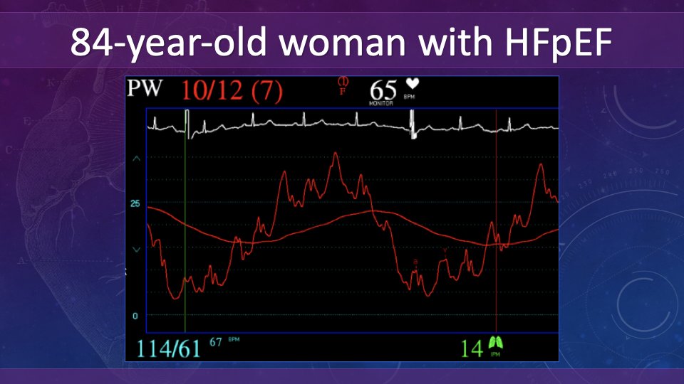 Case: 84 yo woman w/long-standing HFpEF admitted for volume overload. Baseline Cr 2.0 mg/dl. Diuresed 1L on hospital day #1 and Cr  to 2.5 mg/dl. Inpatient team stopped diuresis. Given equivocal volume status -> right heart cath. PCWP reported as 10 mmHg. What would u do next?