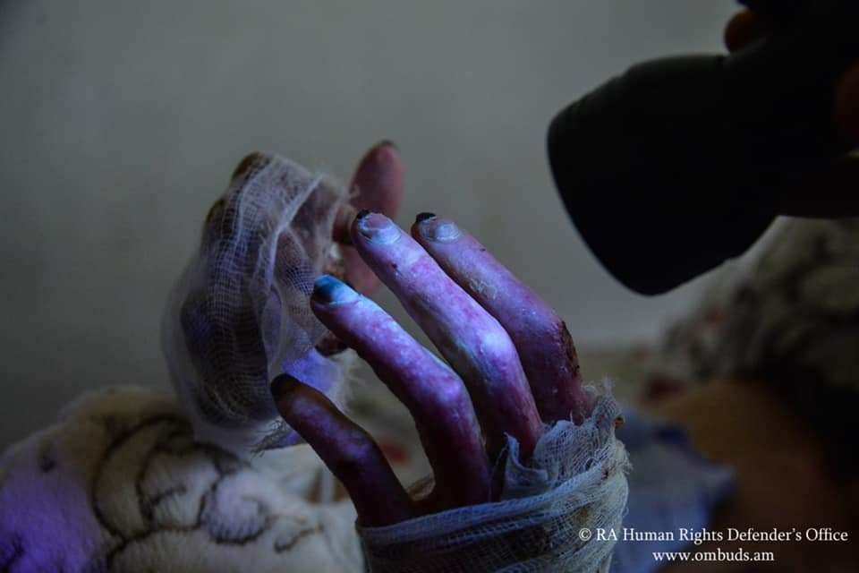 armradio's tweet photo. New evidence on the use of chemical weapons in #Artsakh by the #Azerbaijani Armed Forces https://t.co/XBGwGg8PCv via @armradio https://t.co/lahOlLc1LE