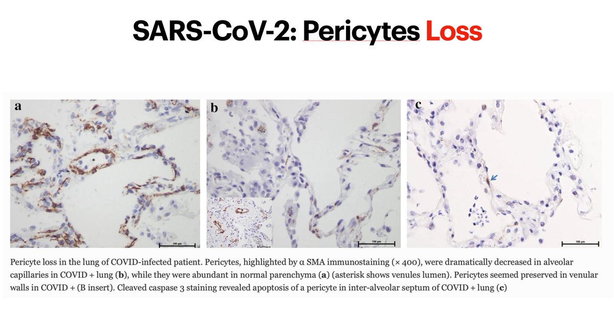 Pericyte loss of the pulmonary endothelium due to SARS-CoV-2 leads to endothelial destabilization, which in turn activates MKs and platelets maturing and residing in the pulmonary capillary spaces.