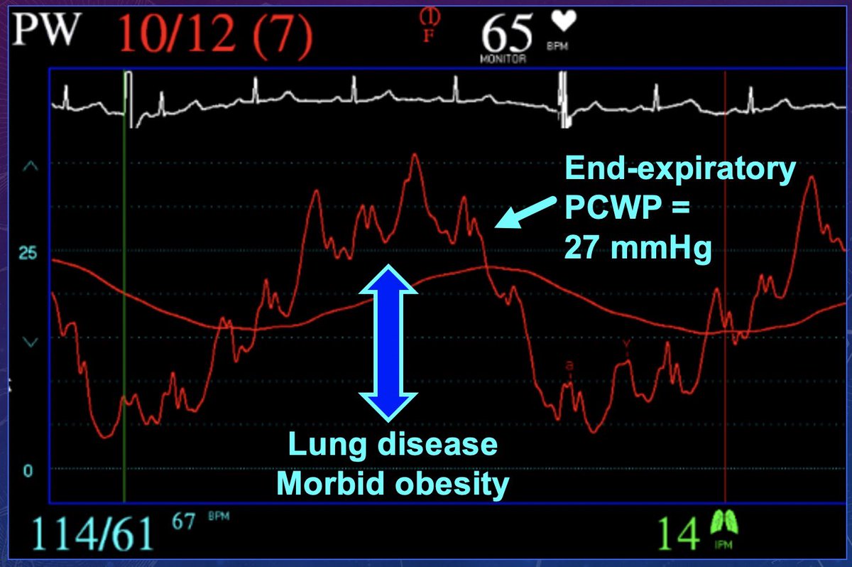 Diurese further. End-expiratory PCWP was 27 mmHg. She was breathing spontaneously (not on ventilator). End-expiratory RA pressure was 16 mmHg. Diuresed net negative 8L further, Cr 2.6 upon discharge from hospital.