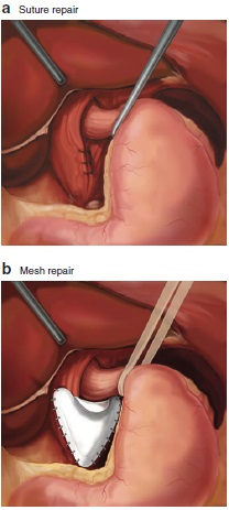BJS (@bjsurgery) on Twitter photo In December's BJS: Tension‐free mesh versus suture‐alone cruroplasty in antireflux surgery: a randomized, double‐blind clinical trial ow.ly/RGOz30rkozv <a href="/AmyLightnerMD/">Amy Lee Lightner, MD</a> <a href="/bplwijn/">Bas Wijnhoven</a> <a href="/des_winter/">Des Winter</a> <a href="/ksoreide/">Kjetil Søreide</a> <a href="/MalinASund/">Malin Sund</a> <a href="/evanscolorectal/">Martyn Evans</a> <a href="/robhinchliffe1/">Robert Hinchliffe</a> <a href="/young_bjs/">Young BJS</a> In December's BJS: Tension‐free mesh versus suture‐alone cruroplasty in antireflux surgery: a randomized, double‐blind clinical trial ow.ly/RGOz30rkozv <a href="/AmyLightnerMD/">Amy Lee Lightner, MD</a> <a href="/bplwijn/">Bas Wijnhoven</a> <a href="/des_winter/">Des Winter</a> <a href="/ksoreide/">Kjetil Søreide</a> <a href="/MalinASund/">Malin Sund</a> <a href="/evanscolorectal/">Martyn Evans</a> <a href="/robhinchliffe1/">Robert Hinchliffe</a> <a href="/young_bjs/">Young BJS</a>