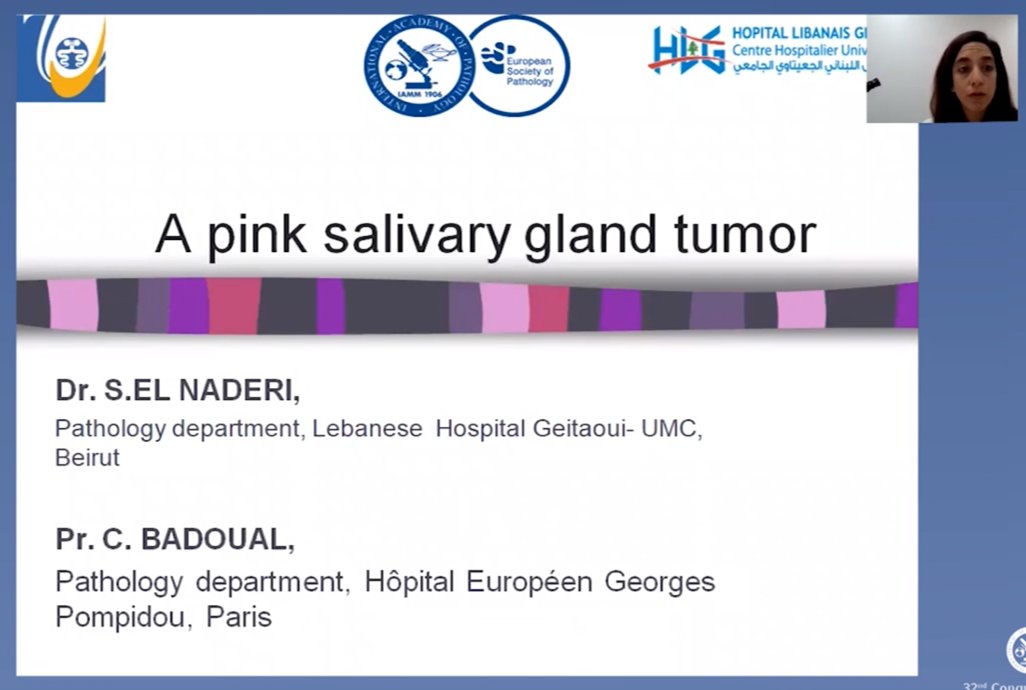 A_Morini_MD's tweet photo. A great case presentation of a so tricky "pink salivary gland tumor" by @LiveLovePath with @CecileBadoualMD. I've already had the chance to see the tumor slides for real!
#virtualpathology2020 #ENTPath
@esp_congress @ESP_Pathology @BritishDivIAP 
And #PrayForLebanon 🇱🇧 🙏❤️ https://t.co/mOwKRs2zG6