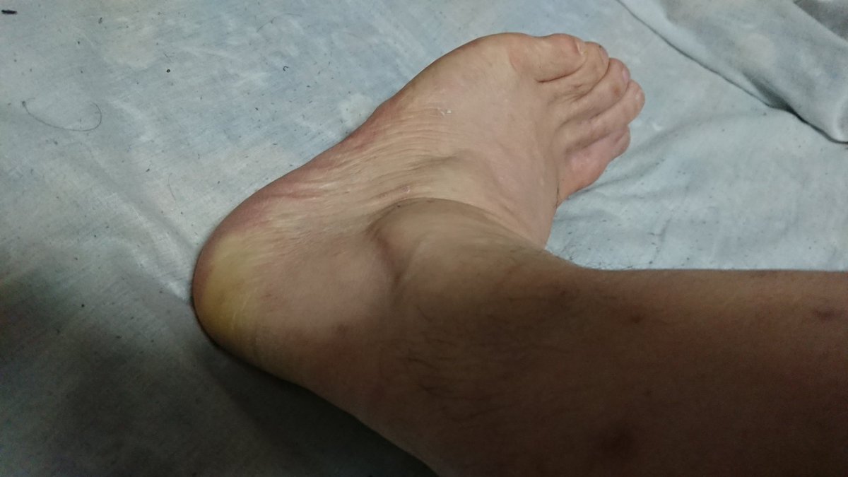 おいも 病院に行きました レントゲンとって 中度 捻挫 剥離骨折だそうで 痛み次第で固定バンドで歩けるならギブスは要らなく 試した上でどうします って質問に対がありました バンドしても普通には歩けないけど 既に爪先歩きで普通の生活送っ おいも 病院に行きました レントゲンとって 中度 捻挫 剥離骨折だそうで 痛み次第で固定バンドで歩けるならギブスは要らなく 試した上でどうします って質問に対がありました バンドしても普通には歩けないけど 既に爪先歩きで普通の生活送っ