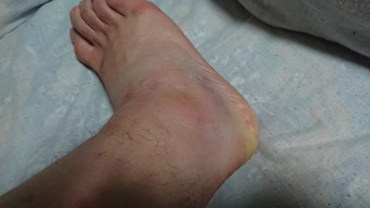 おいも 病院に行きました レントゲンとって 中度 捻挫 剥離骨折だそうで 痛み次第で固定バンドで歩けるならギブスは要らなく 試した上でどうします って質問に対がありました バンドしても普通には歩けないけど 既に爪先歩きで普通の生活送っ おいも 病院に行きました レントゲンとって 中度 捻挫 剥離骨折だそうで 痛み次第で固定バンドで歩けるならギブスは要らなく 試した上でどうします って質問に対がありました バンドしても普通には歩けないけど 既に爪先歩きで普通の生活送っ