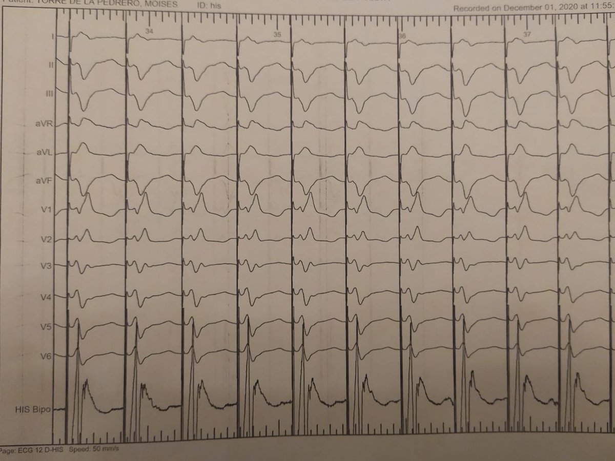58-yo patient, LVEF 32%, no scar on MRI and intermitent LBBB. His pacing - CRT. Intracardiac recording initially showing low rate-dependent  LBBB. After implanting an electrode in His, mechanical RBBB, rate dependent AV block and no block pacing his at high rate.