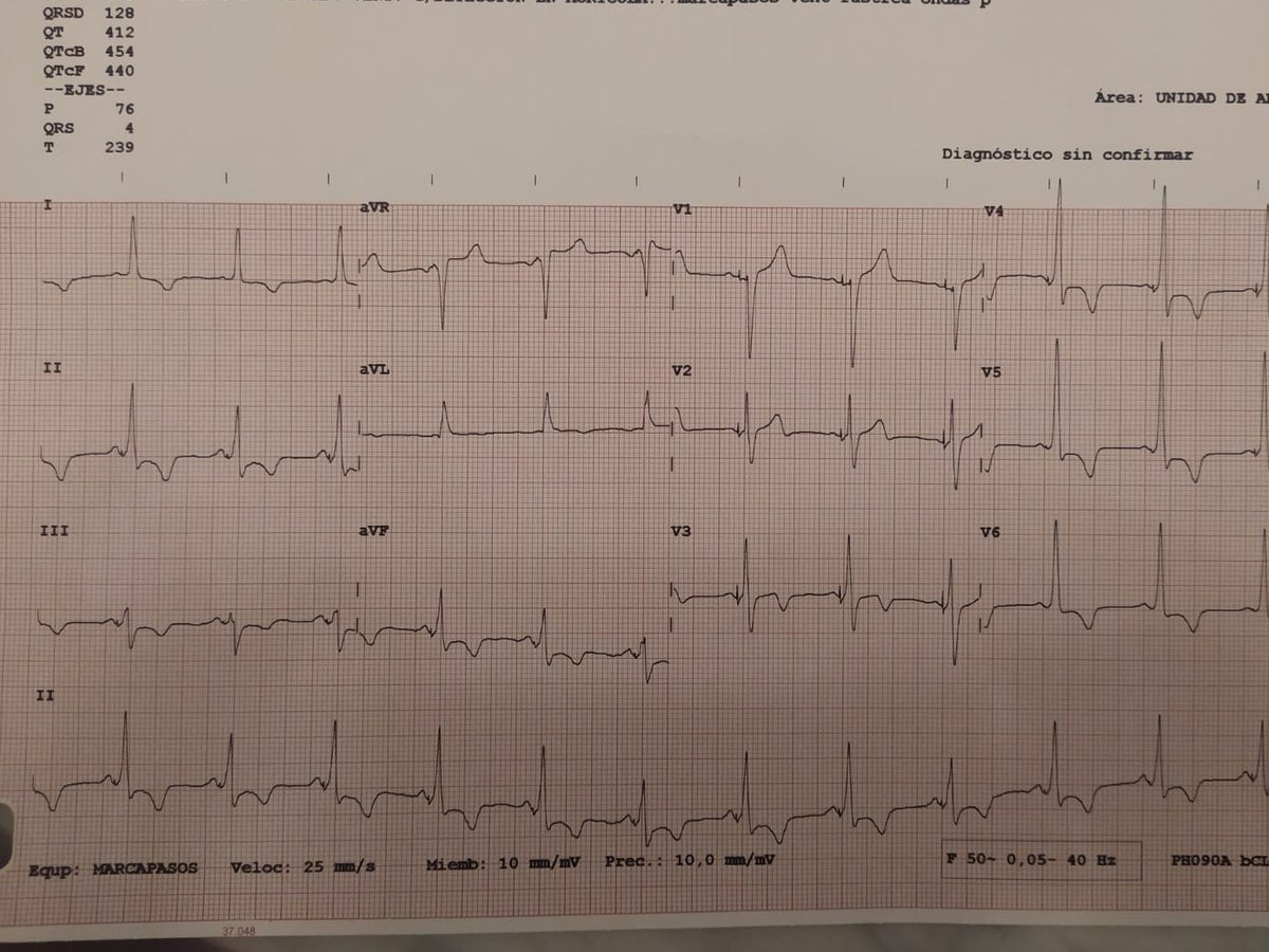 CORRECTION OF RATE DEPENDENTE LBBB WITH HBP. 24 hours later mechanical RBBB has resolved. Rate dependent LBBB persists; 1.1 conduction with selective capture of his bundle and normal QRS at high rates.