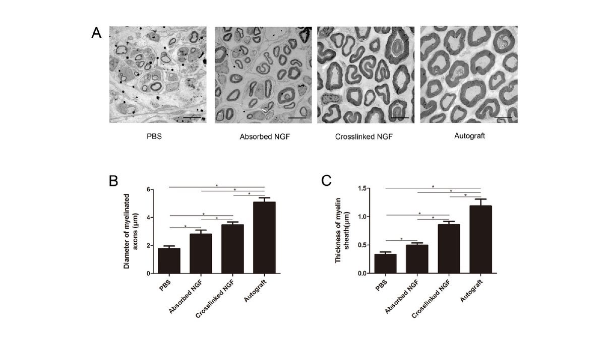 ArtifOrgans's tweet photo. #Nerve guidance conduit promoted peripheral nerve #regeneration in rat
#OnlineFirst👉https://t.co/xX6yfAjF7A
#Huizhou #HefeiCity #ZigongCity #Shanghai #Suzhou 🇨🇳
#nerveinjury #nervegrowthfactor https://t.co/EGs9p4HWWe
