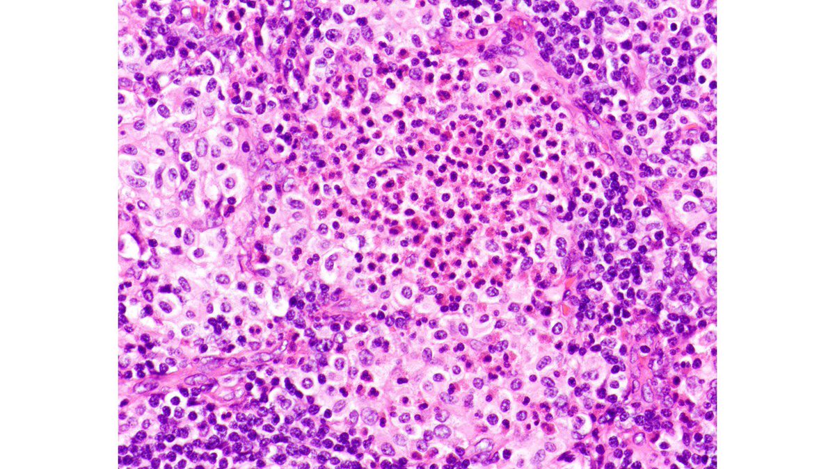 judith_ferry's tweet photo. Pathologists! What’s your Dx for this periportal LN from older man with leukocytosis, anemia, thrombocytopenia, absolute monocytosis, eosinophilia and lymphadenopathy? What other work up is warranted? #hemepath https://t.co/OX2bGqNwZF