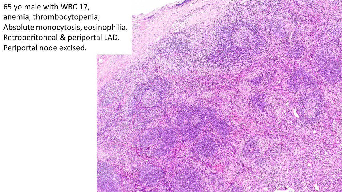 judith_ferry's tweet photo. Pathologists! What’s your Dx for this periportal LN from older man with leukocytosis, anemia, thrombocytopenia, absolute monocytosis, eosinophilia and lymphadenopathy? What other work up is warranted? #hemepath https://t.co/OX2bGqNwZF