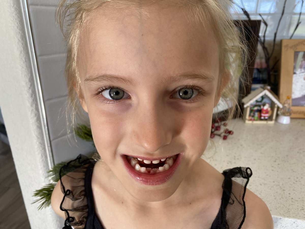 CrashGladys's tweet image. So... another thing happened... 😂🦷 #WhenItRainsItPours #2Teeth in #3Days #ToothFairy 🦷🧚is gonna be broke! 😂