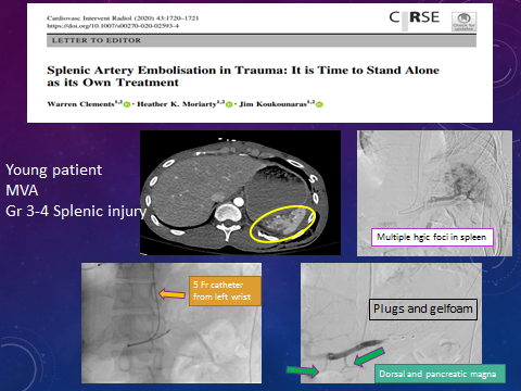 Trauma Surgery Colleagues: "IT IS TIME for change of attitude and nomenclature to reflect that Splenic Artery Embolization ( #SAE) is its own distinct procedure, rather than being constrained as a faceless nonoperative adjunct" is why: 20 min, pinhole in wrist, Spleen saved