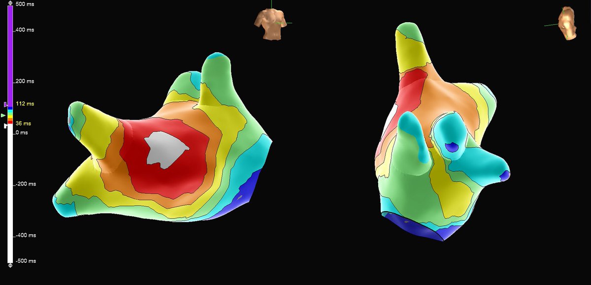 murphy_lzy's tweet photo. Distal Bachmann bundle was quite distinct in this case mapped with HD Grid
#AbbottEmp #HDGrid #Epeeps @EricTSLim @JeffZhanghk2017 @Mya49099911 @sabarisarav @MunishSehgal17 @rohanmore2010 @sachinjv @Hapa_EP @szufski1 @forkknifecab_EP @ep_nerd https://t.co/GhEQ2mtVT0