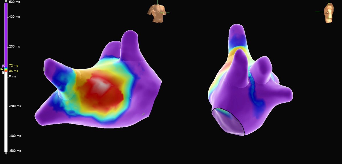 murphy_lzy's tweet photo. Distal Bachmann bundle was quite distinct in this case mapped with HD Grid
#AbbottEmp #HDGrid #Epeeps @EricTSLim @JeffZhanghk2017 @Mya49099911 @sabarisarav @MunishSehgal17 @rohanmore2010 @sachinjv @Hapa_EP @szufski1 @forkknifecab_EP @ep_nerd https://t.co/GhEQ2mtVT0