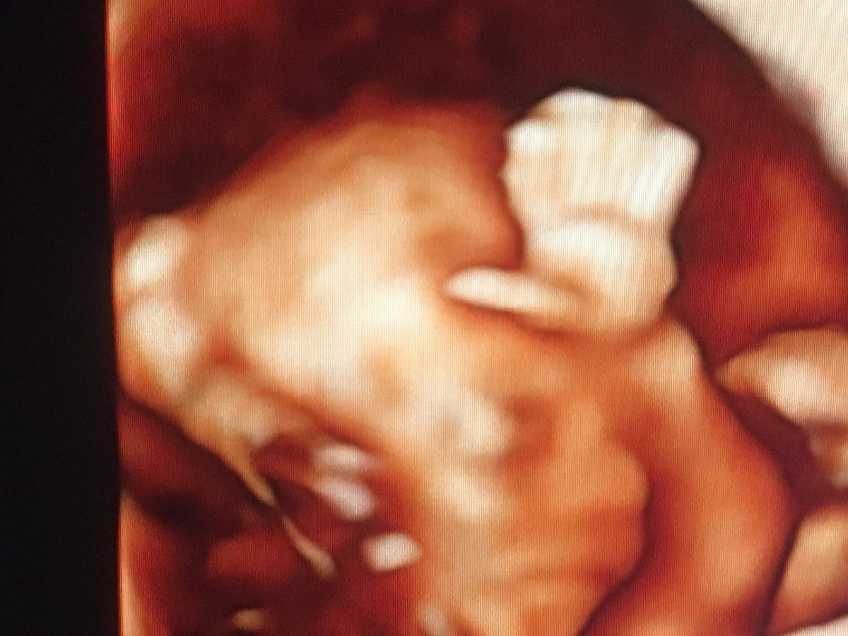 fetal_uk's tweet image. See baby in more detail with a 3D scan🖐️

⏲️From 12 weeks 
👄See eyes, nose &amp;amp; mouth
❤️Have extra bonding time w/ baby

Pls note: 3D imaging has limited diagnostic value. Good images not always poss.

More info: bit.ly/33QsxQn

#3dbabyscan #fetalmedicineuk