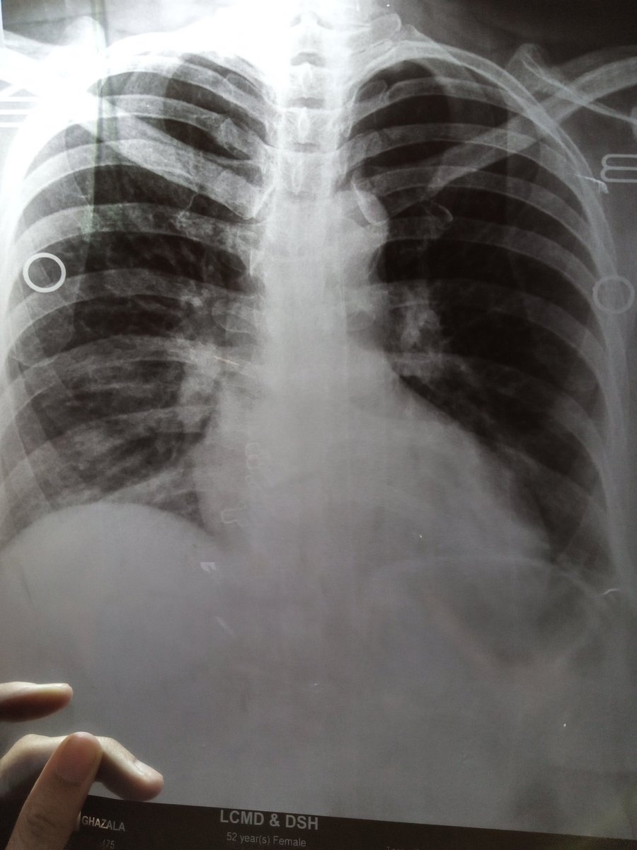 Don't take this shit lightly. Take steam & do ablution as much as possible. Go for quarantine. Try to avoid going in public. Note 3: Chest X-ray is important as it shows the infiltration (smoke or fog around your rib cage) if you're having coughs. (Can be seen in pic below)