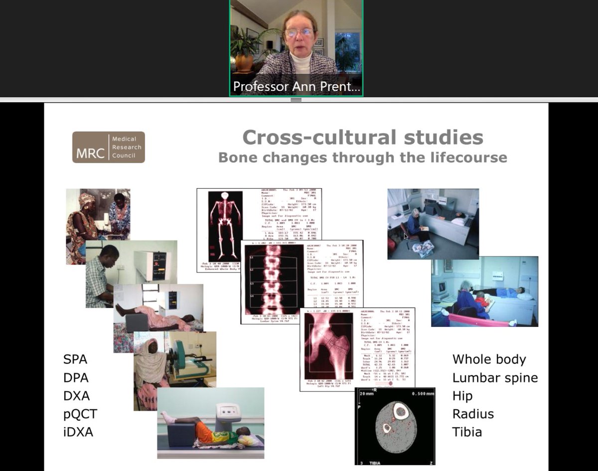 SAMSON_tweets's tweet photo. Really enjoying tuning into the @NutritionSoc 2020 Awards Ceremony where Prof Ann Prentice has been awarded the 2020 #nutsoc #Widdowson Award. Much of Prof Prentice's research has taken place @mrcunitgambia and has focused on the relationships between nutrition and bone health. https://t.co/jzS9k0cMw9