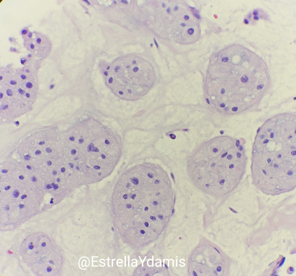 EstrellaYdamis's tweet photo. Beautiful example of a chordoma; brachyury stain #BST_Path #neuropathology #pathology https://t.co/qx7xBrlYAM
