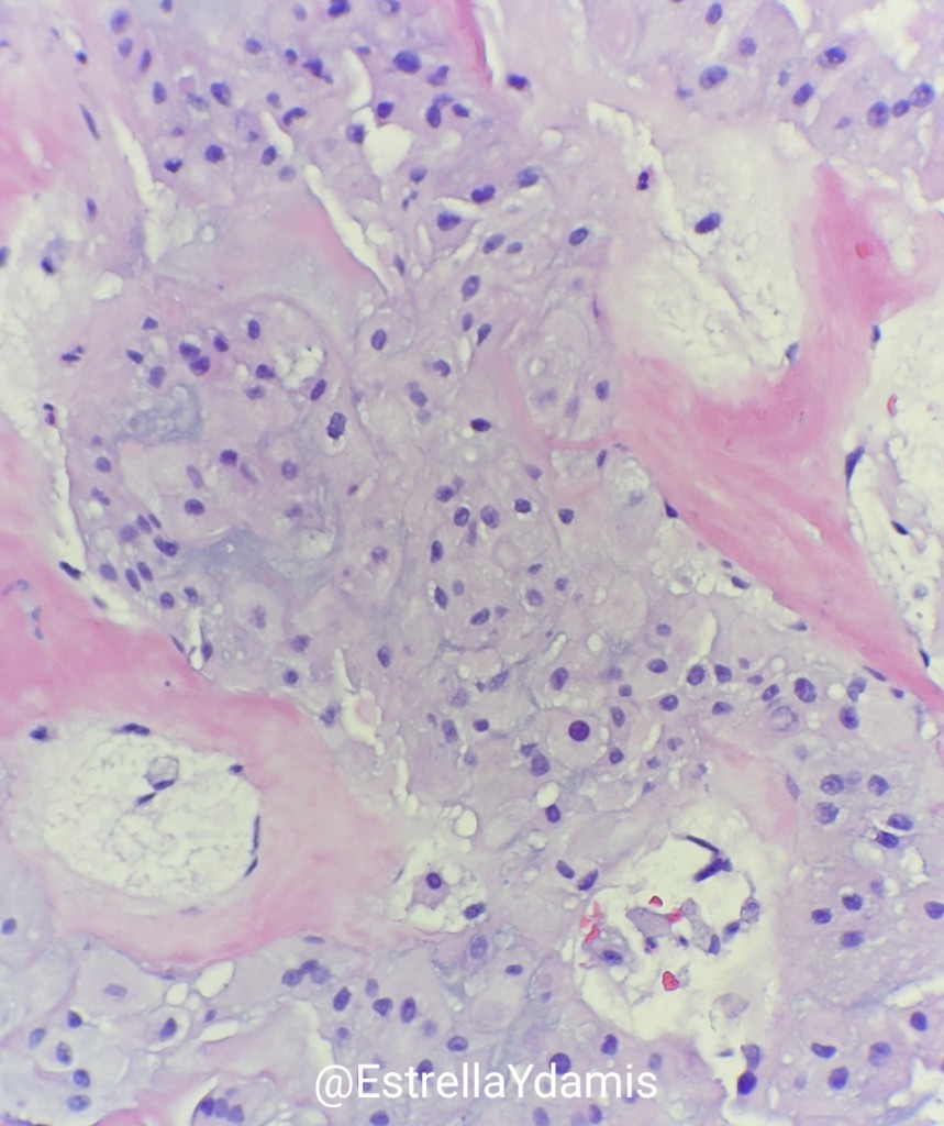 EstrellaYdamis's tweet photo. Beautiful example of a chordoma; brachyury stain #BST_Path #neuropathology #pathology https://t.co/qx7xBrlYAM