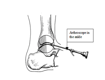Did you know that we provide advanced surgical procedures like ankle arthroscopy to diagnose & repair issues without major surgery? Cameras & instruments are inserted through small incisions, which reduces infection risk & healing times. Call us for more info! #anklearthroscopy