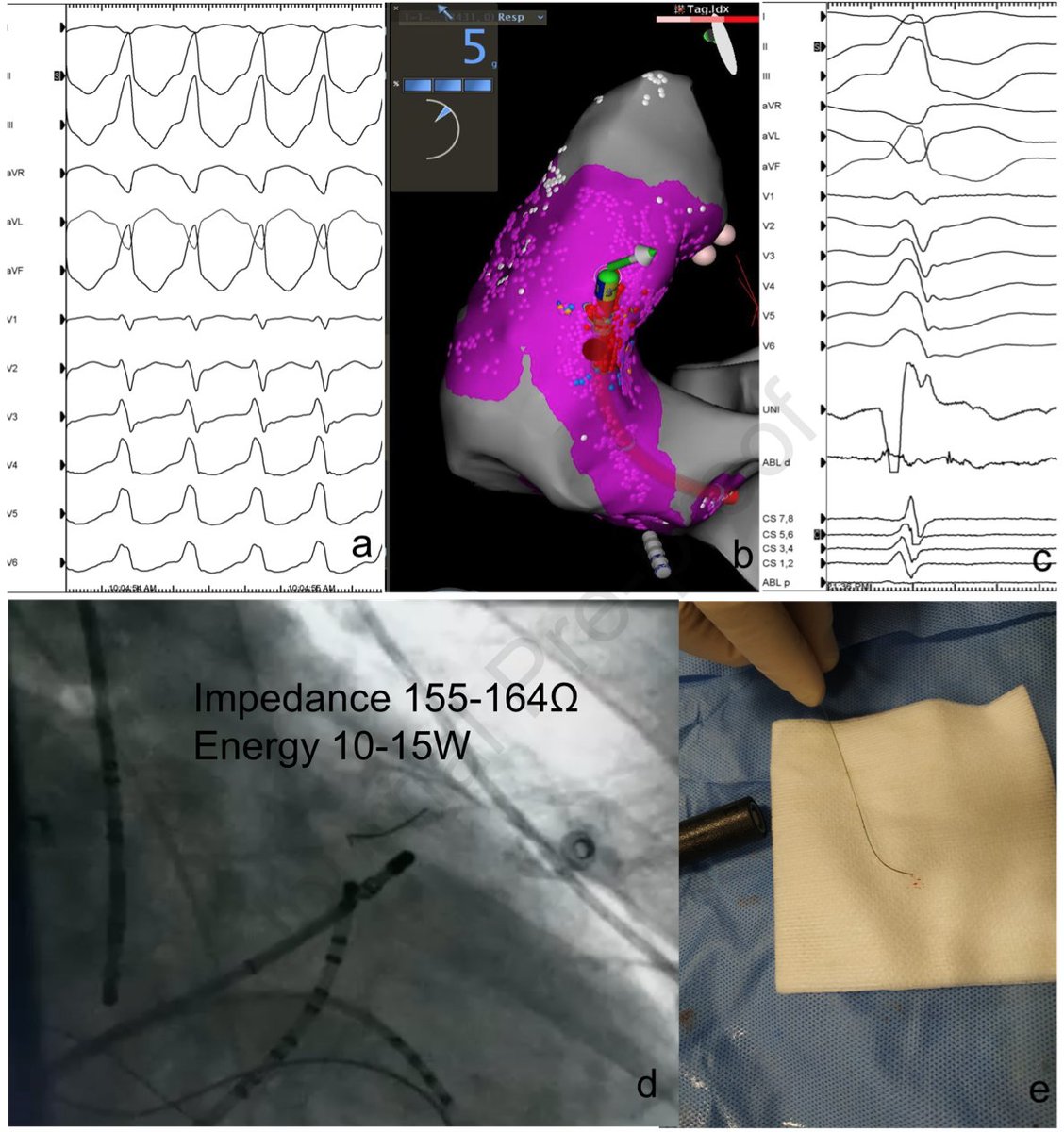 Novel technique targeting left ventricular summit premature ventricular contractions using radiofrequency ablation through a guidewire heartrhythmcasereports.com/article/S2214-…