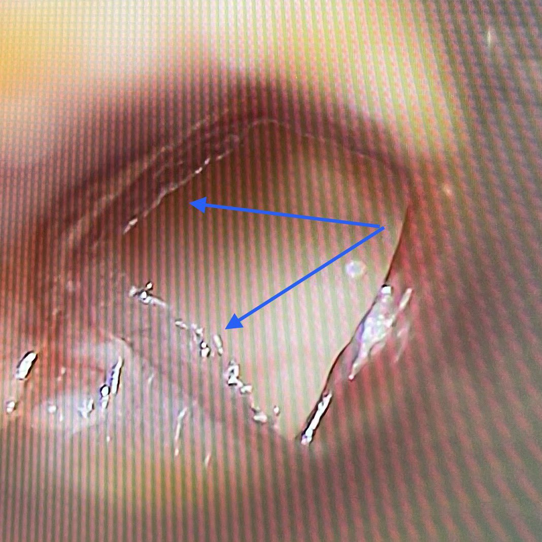 WilliamRBlythe's tweet photo. General ENT Clinic today: 1) Site of precious SCCA of right larynx after successful endoscopic resection NED; 2) Acute bullous myringitis in COVID+ patient; 3) Left TVC polyp;) Epithelium growing across traumatic TM perforation. #ENTLife #GeneralENT https://t.co/0Zg4Bl0FzO