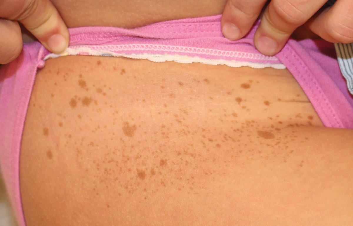 neonatal_med's tweet photo. Segmental form of mosaic neurofibromatosis 1
For more details visit: https://t.co/yTB0RExRKM https://t.co/E6uBiZwuyT