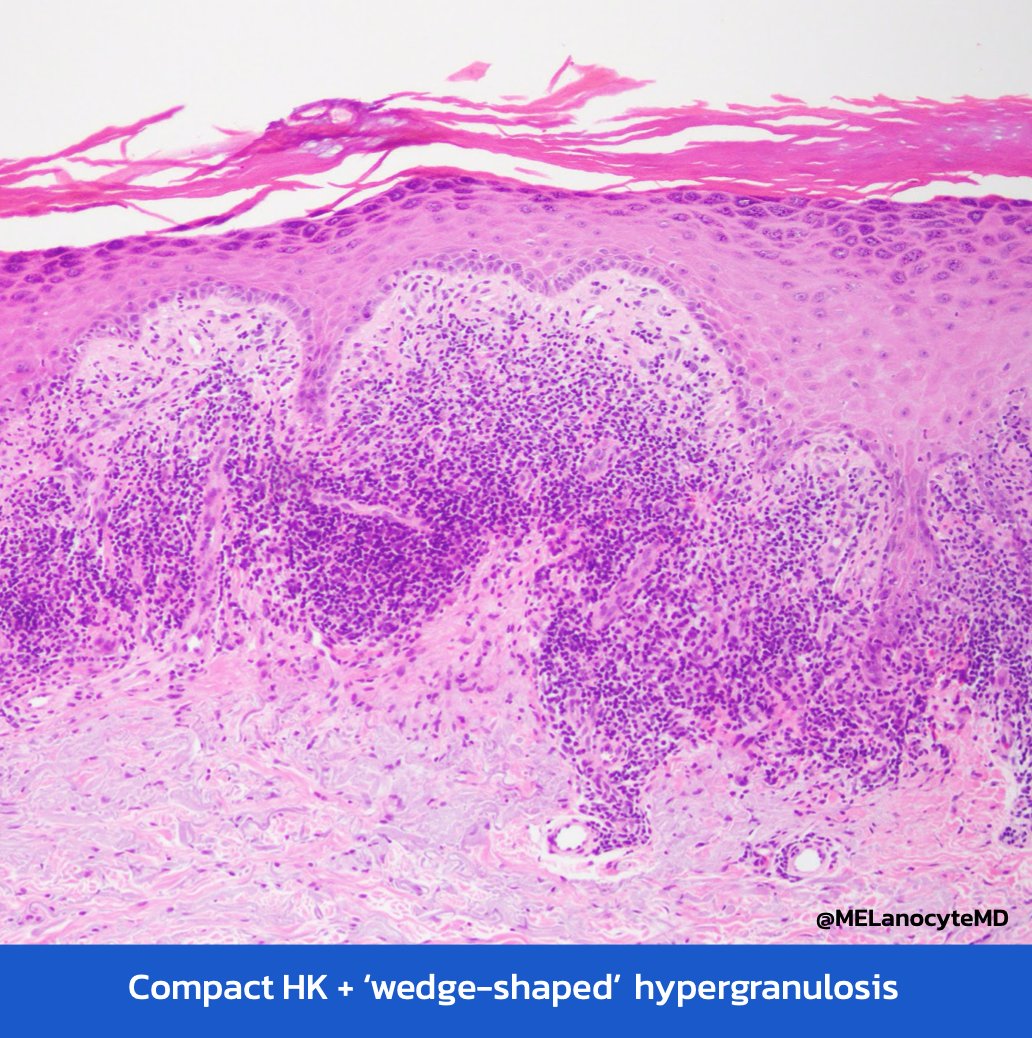 MELanocyteMD's tweet photo. Lichen planus:
👩‍⚕️ 5Ps, middle aged ♀️>♂️
👩‍⚕️ Wrists, shins, oral mucosa
🔬 Compact HK
🔬 Wedge-shaped hypergranulosis
🔬 Interface ∆, sawtooth rete
🔬 Lichenoid infiltrate (LCs &amp; HCs)
🔬 Scattered dyskeratosis
💡 Variants: hypertrophic, atrophic, bullous
#dermpath #pathtweetorial https://t.co/WPftJjTjmy