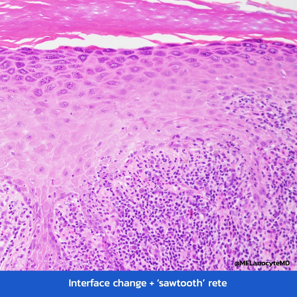 MELanocyteMD's tweet photo. Lichen planus:
👩‍⚕️ 5Ps, middle aged ♀️>♂️
👩‍⚕️ Wrists, shins, oral mucosa
🔬 Compact HK
🔬 Wedge-shaped hypergranulosis
🔬 Interface ∆, sawtooth rete
🔬 Lichenoid infiltrate (LCs &amp; HCs)
🔬 Scattered dyskeratosis
💡 Variants: hypertrophic, atrophic, bullous
#dermpath #pathtweetorial https://t.co/WPftJjTjmy