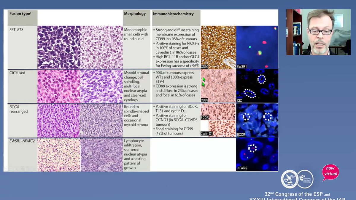 Do you want to know whats new in Soft tissue tumors? #virtualpathology2020 #BSTpath Great session with <a href="/EnriquedeAlava/">Enrique de Álava</a>